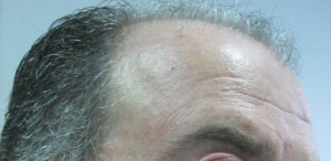 Alopecia androgenética en un hombre