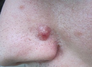 basocelular