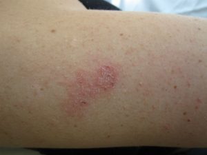 Eczema seco