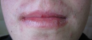 labios isotretinoina