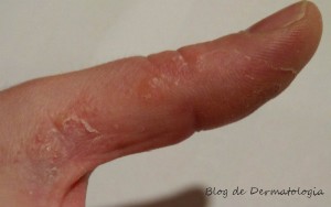 vesiculas dedo eczema dishidrótico
