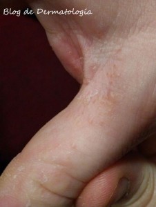 ampollitas dedos eczema dishidrótico