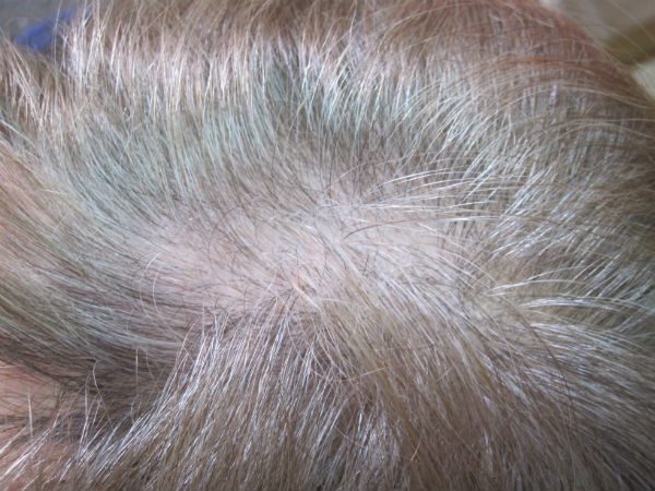 alopecia androgenética