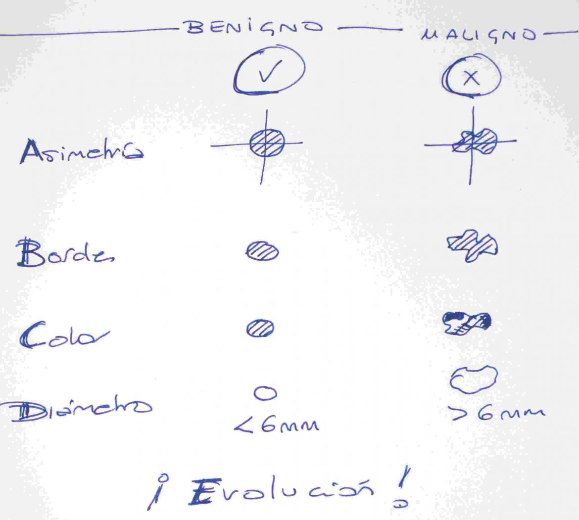 abcde3 Regla ABCDE para lunares