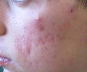 acné