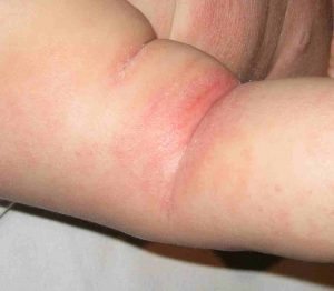 dermatitis atopica