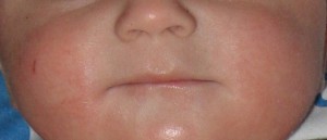 dermatitis atopica
