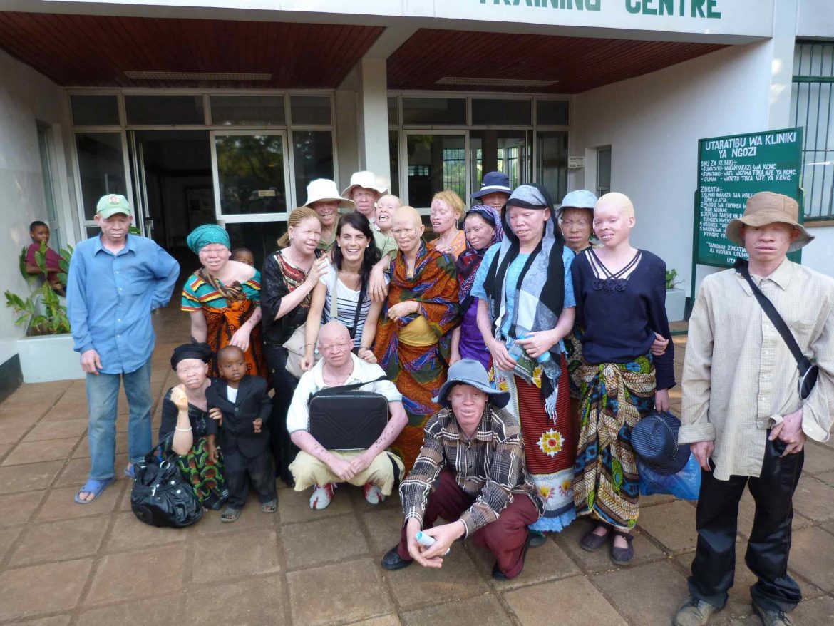 albinismo en África