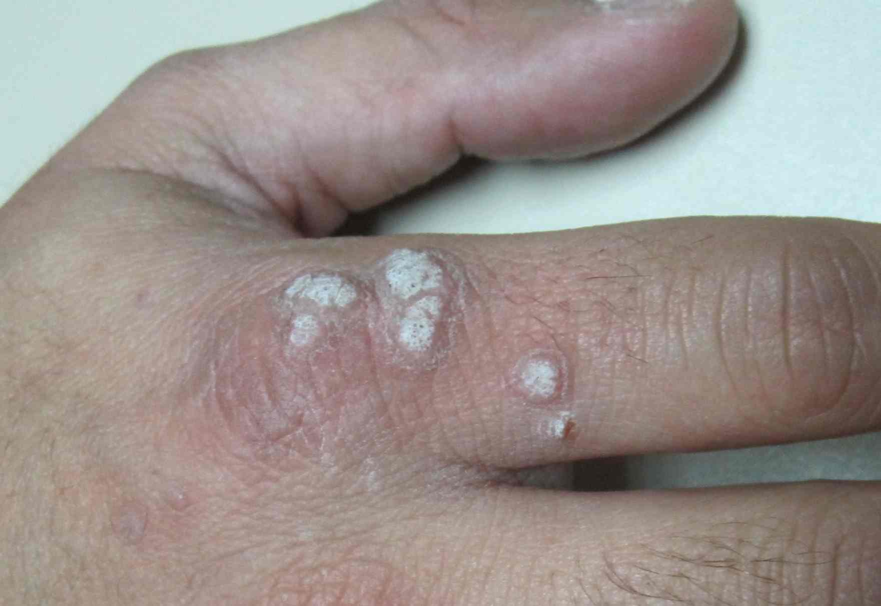 cu mâncărime condiloame papilloma virus vaccino toscana