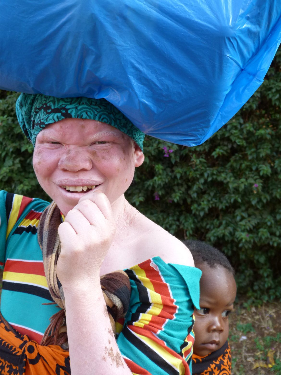 Albinismo en África