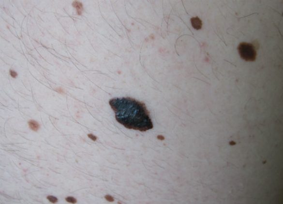melanoma