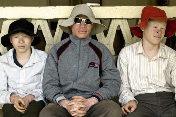 Tres personas albinas