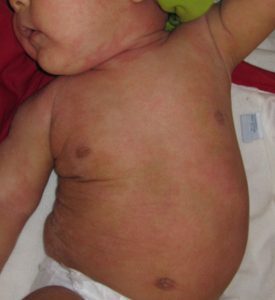 Niño con dermatitis atópica