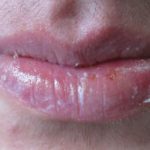 labios secos por isotretinoína