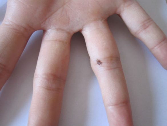 nevus melanocitico mano