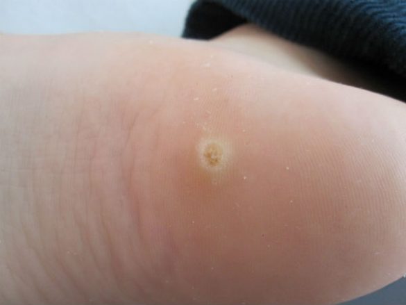 verruga plantar