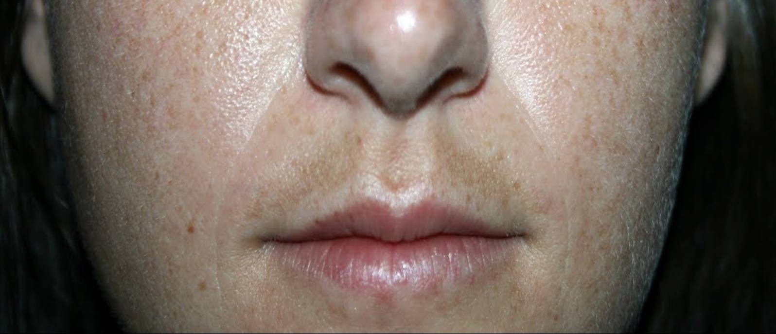 Manchas en la piel de la cara: melasma | Dra. LOREA BAGAZGOITIA