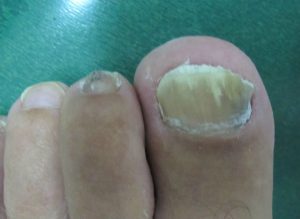Onicomicosis: hongos en las uñas de los pies - Dra. LOREA BAGAZGOITIA
