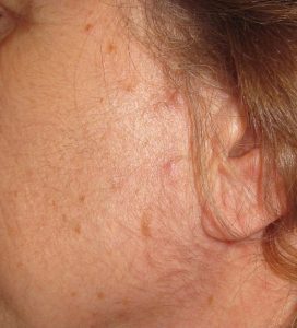 embarazada descanso Indefinido Minoxidil para la alopecia androgenética en hombres y mujeres | Blog de  Dermatología - Dra. Lorea Bagazgoitia