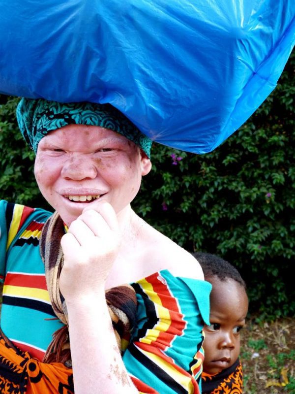 albinismo Tanzania