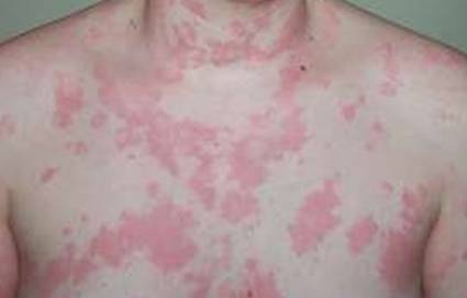 Urticaria: picor y ronchas que vienen y van - Dra. LOREA BAGAZGOITIA