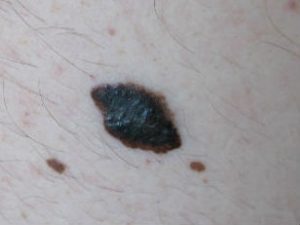 melanoma