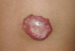 hemangioma