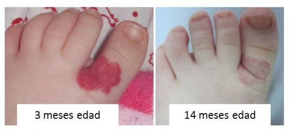hemangioma invol