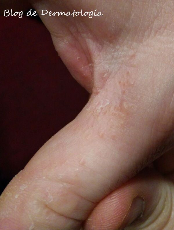 granitos en la piel de los dedos
