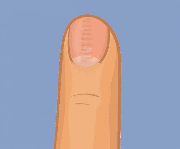 distrofia canaliforme