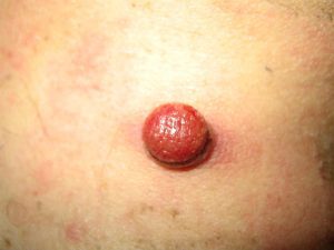 Una verruga que sangra: granuloma piogénico | LOREA