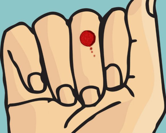 granuloma piogénico