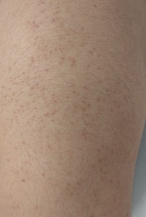 granitos en la piel del brazo