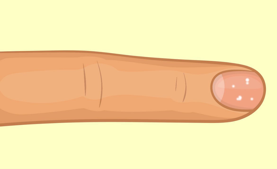 Por qué aparecen manchas blancas en las uñas de los dedos y cómo  eliminarlas  leuconiquia  tratamiento  atmp  Salud  La República