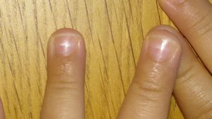 Manchas blancas en las uñas | Doctora Lorea Bagazgoitia Dermatología