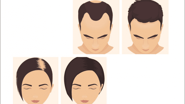 Minoxidil oral para la alopecia androgenética - LOREA BAGAZGOITIA