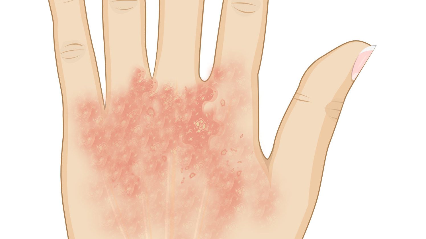 Dermatitis por lavado de manos | Dra. LOREA