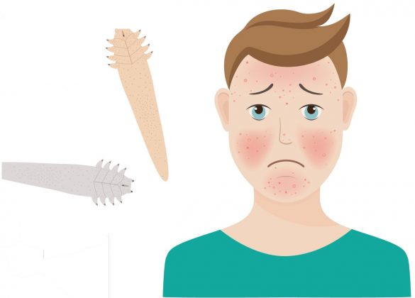 demodex rosacea