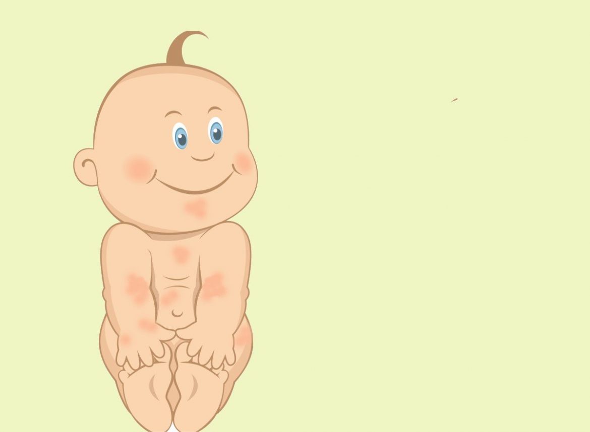 dermatitis atopica se cura