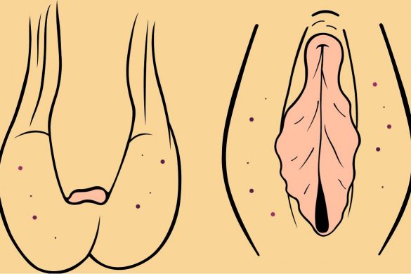 multiple laryngeal papilloma condiloame în locuri intime pentru bărbați