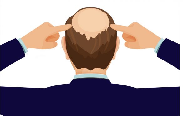 dutasteride para alopecia androgenética