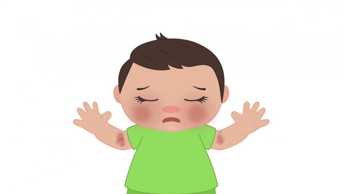 actualización sobre prevención de la dermatitis atópica