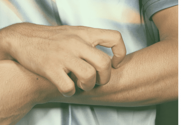 picor dermatitis atópica