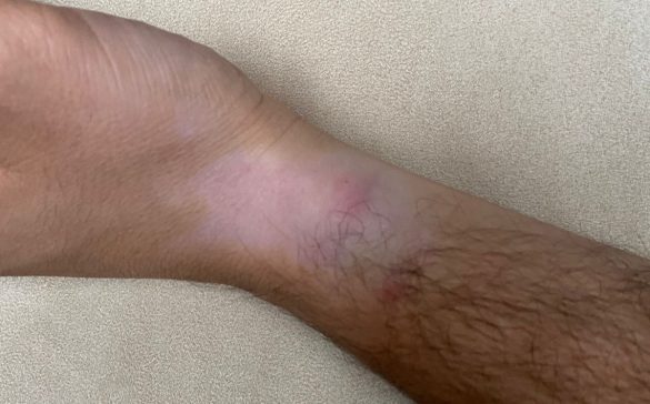 hipopigmentación por corticoides