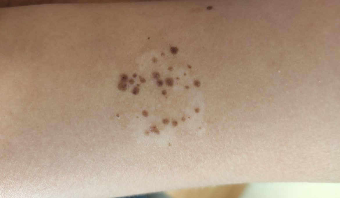 spilus 2 nevus spilus