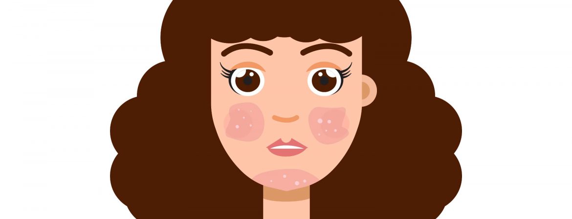 rosacea