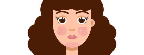 rosacea