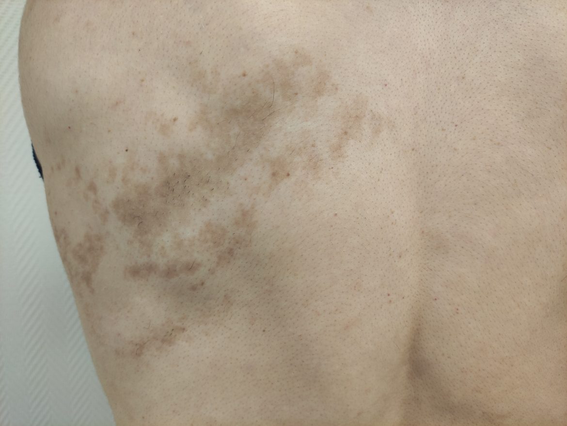nevus de Becker