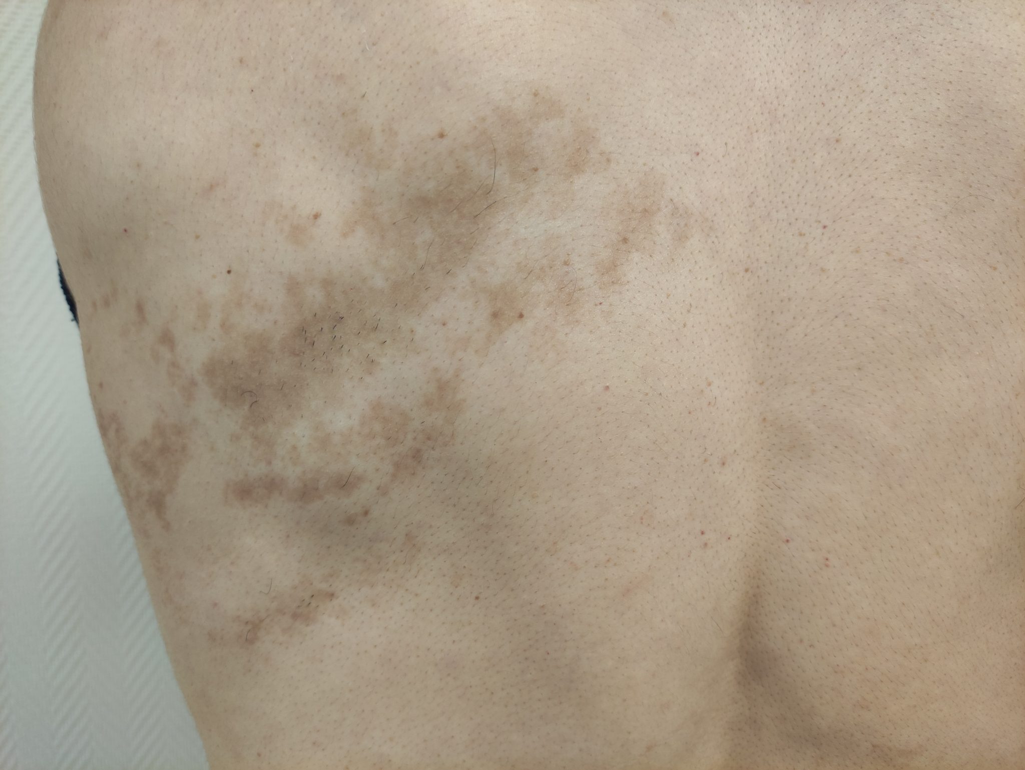 nevus de becker Dra. LOREA BAGAZGOITIA