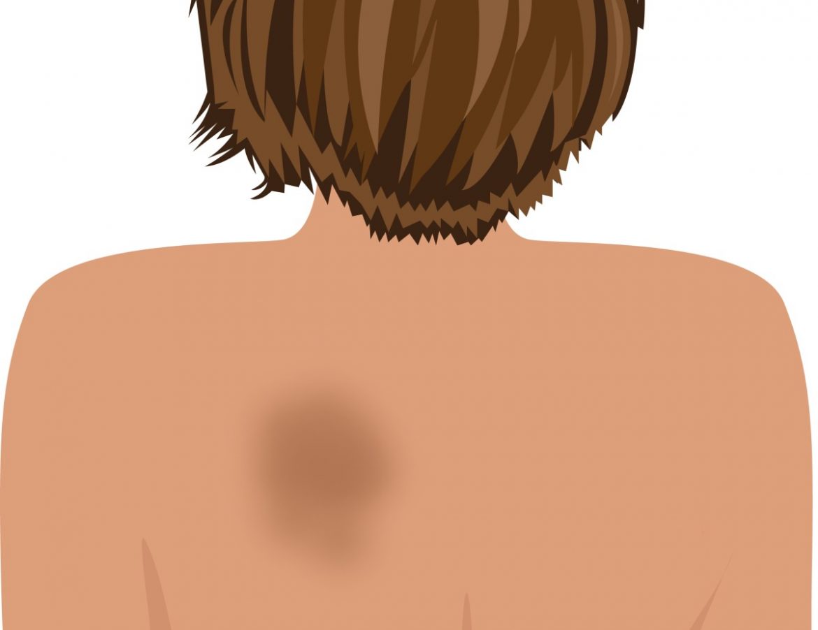 notalgia parestesica mancha en la espalda que pica